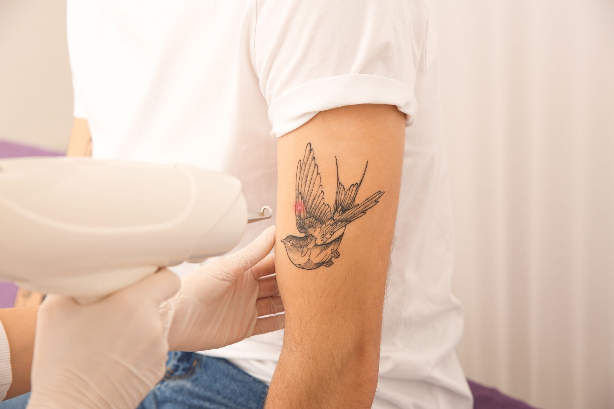 Close-up of laser tattoo removal procedure on a man’s forearm
