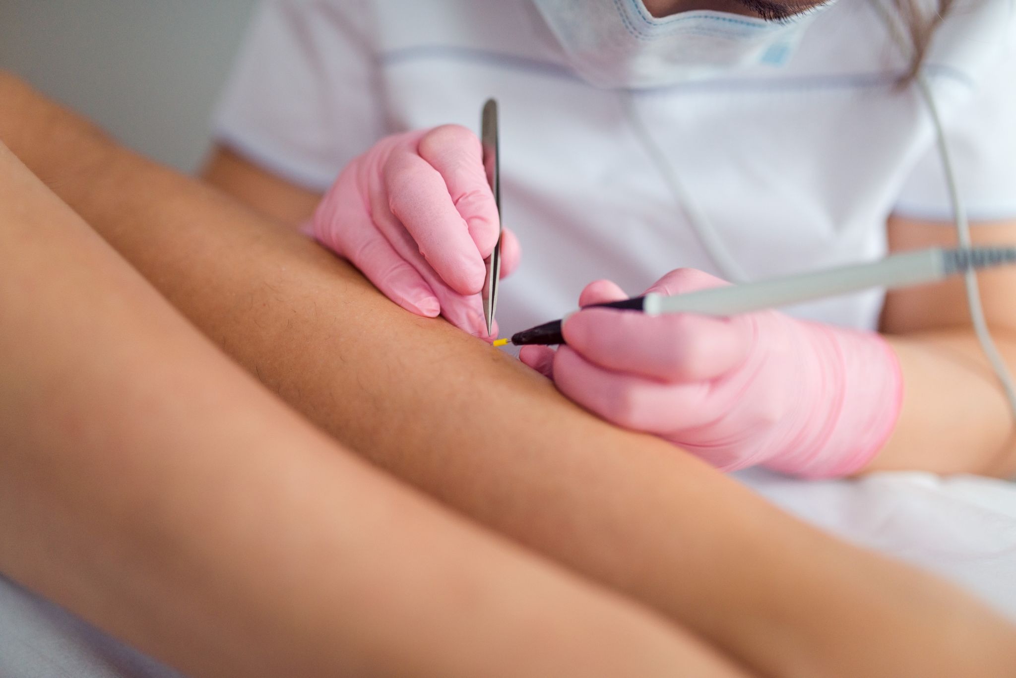 Professional hair removal on legs using a precise electroepilation technique in a clinical setting