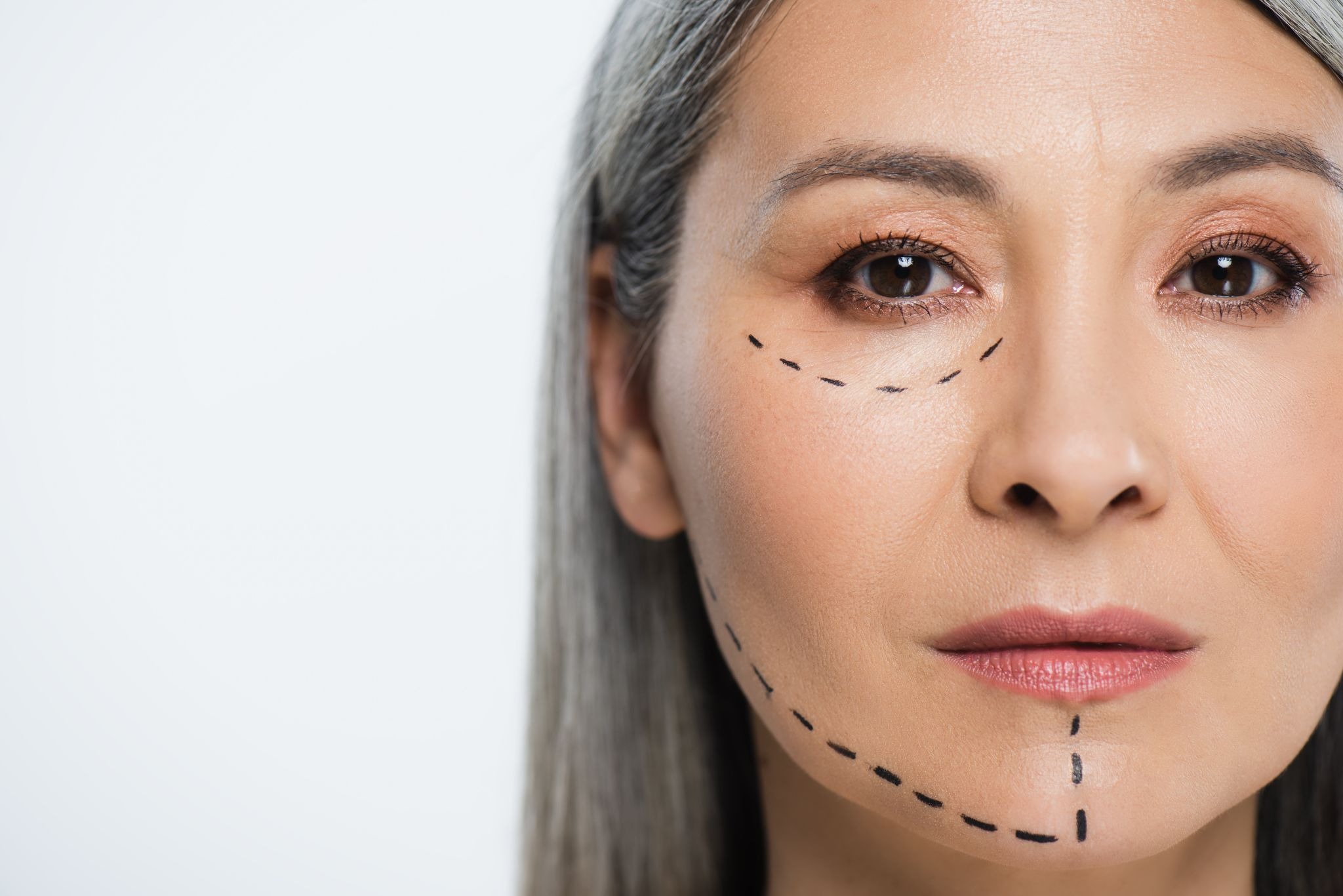 Woman’s face with surgical markings before a facelift procedure