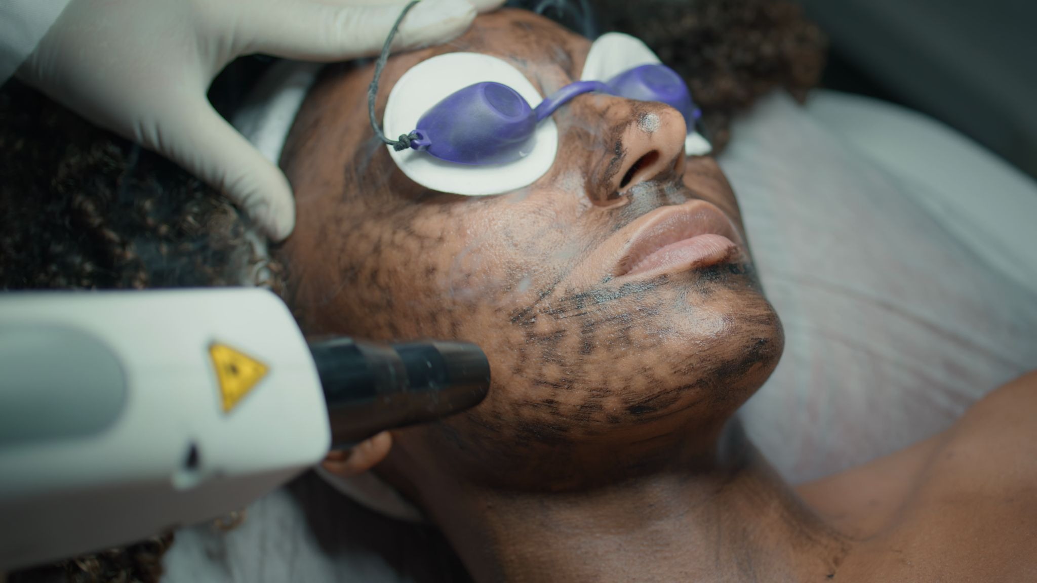 Woman receiving laser facial treatment to reduce pigmentation and improve skin tone