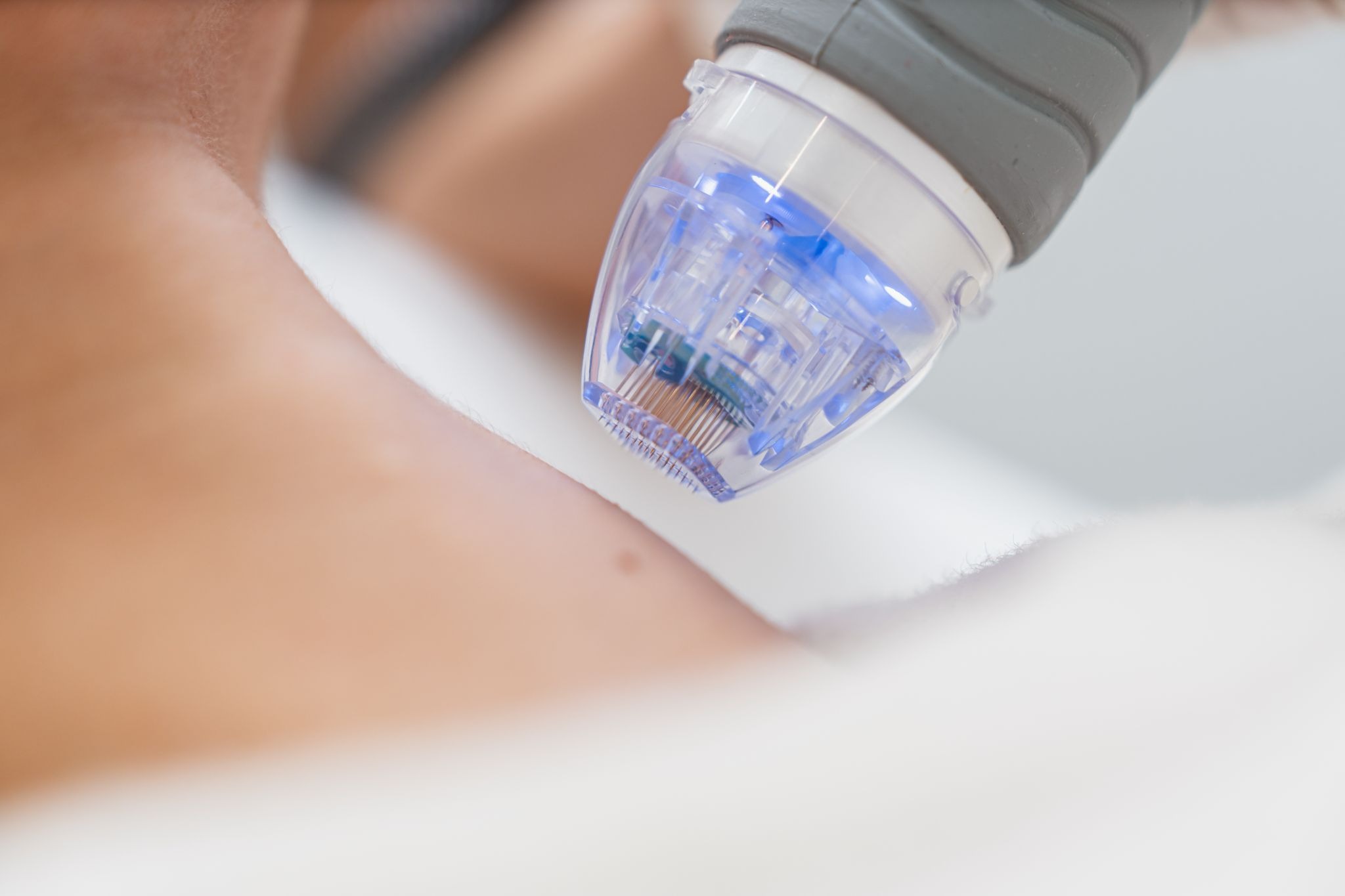 Microneedling treatment on the neck to improve skin texture and support rejuvenation