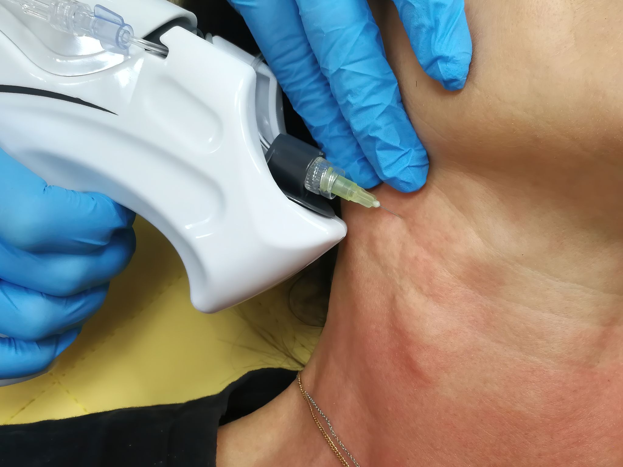 Detailed view of plasma fibroblast therapy tightening neck skin
