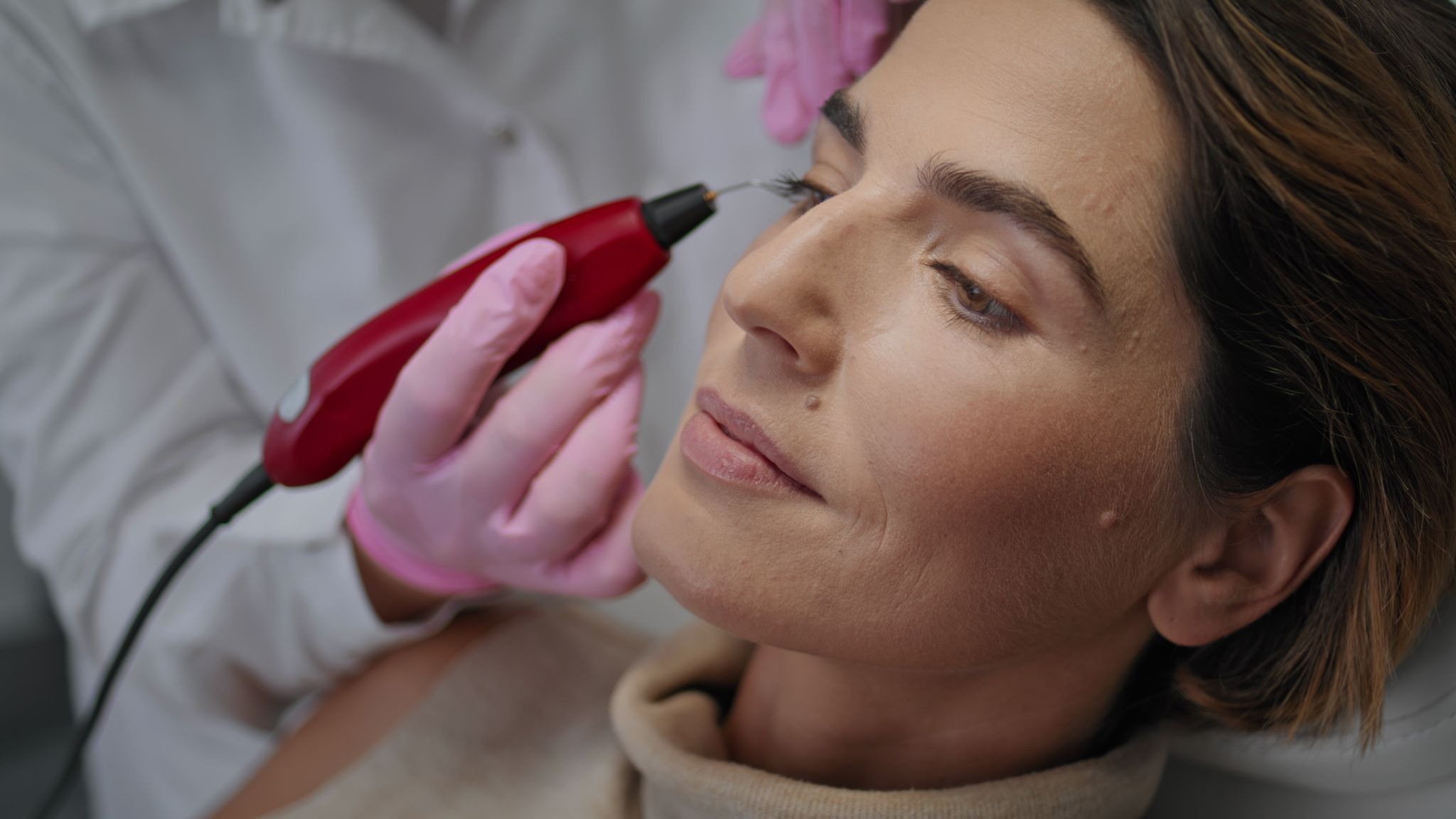 Cosmetic procedure improving eye wrinkles using fibroblast technology