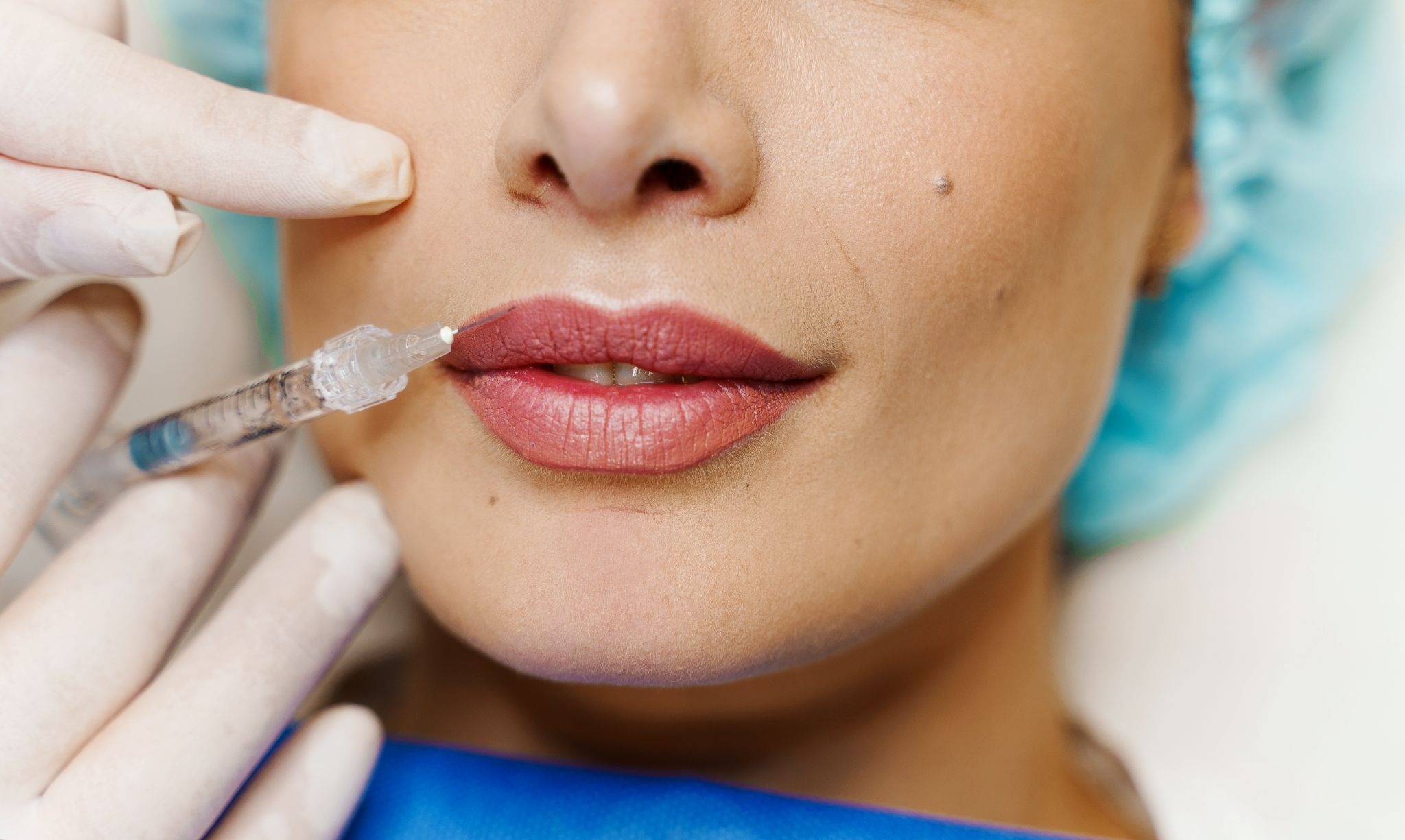 Close-up of a woman getting lip filler injections for enhanced lip volume
