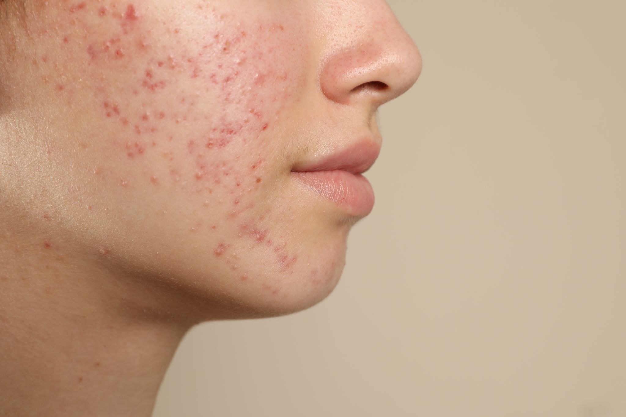 Partial view of a teenage girl’s face with visible hormonal acne