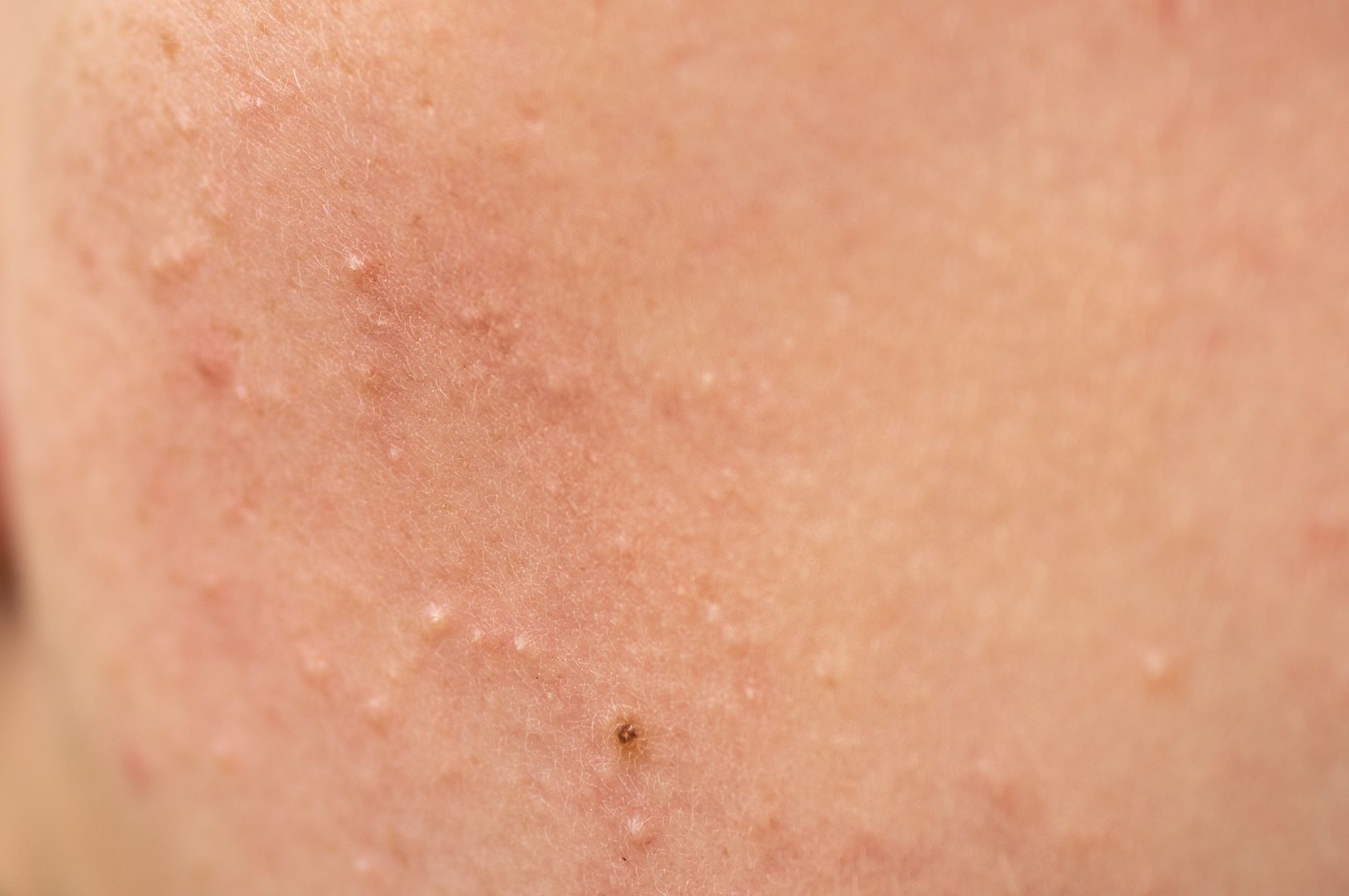 Extreme close-up of human skin with comedonal acne, showing visible blackheads, whiteheads, clogged pores, and uneven skin texture