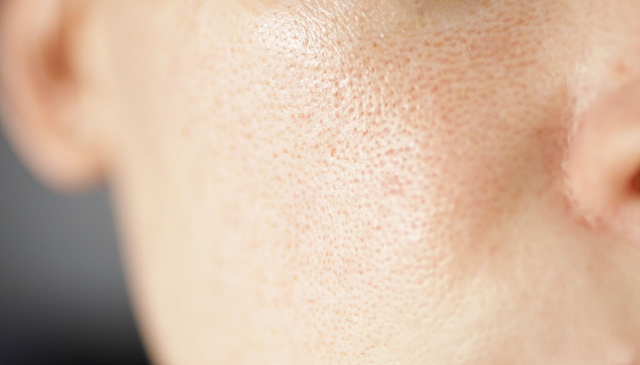 Close-up of facial skin showing visible enlarged pores and uneven texture