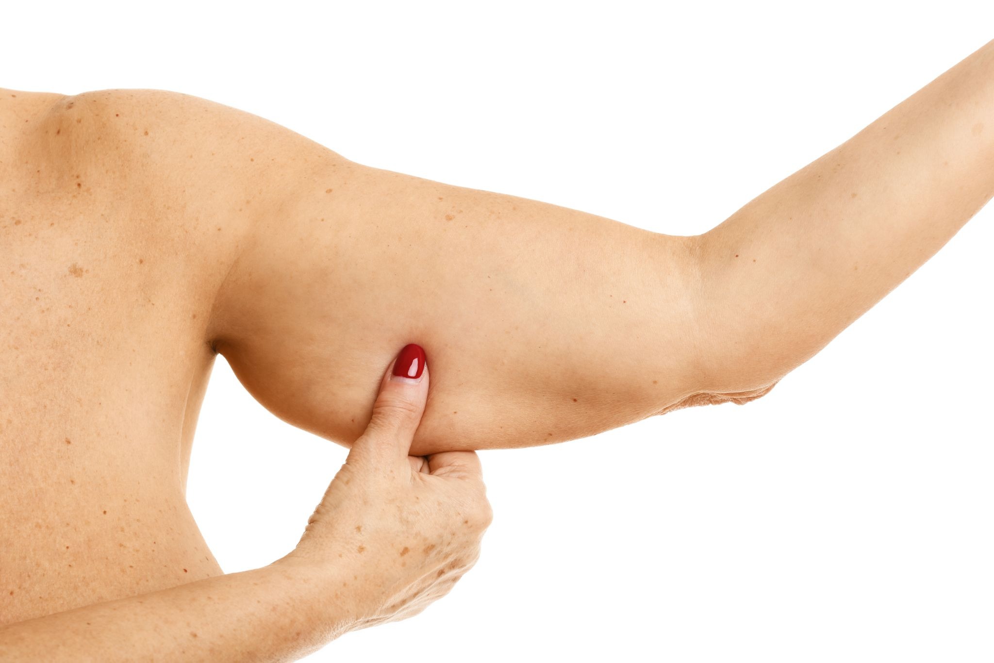 Partial view of a woman touching the loose skin on her bicep and upper arm