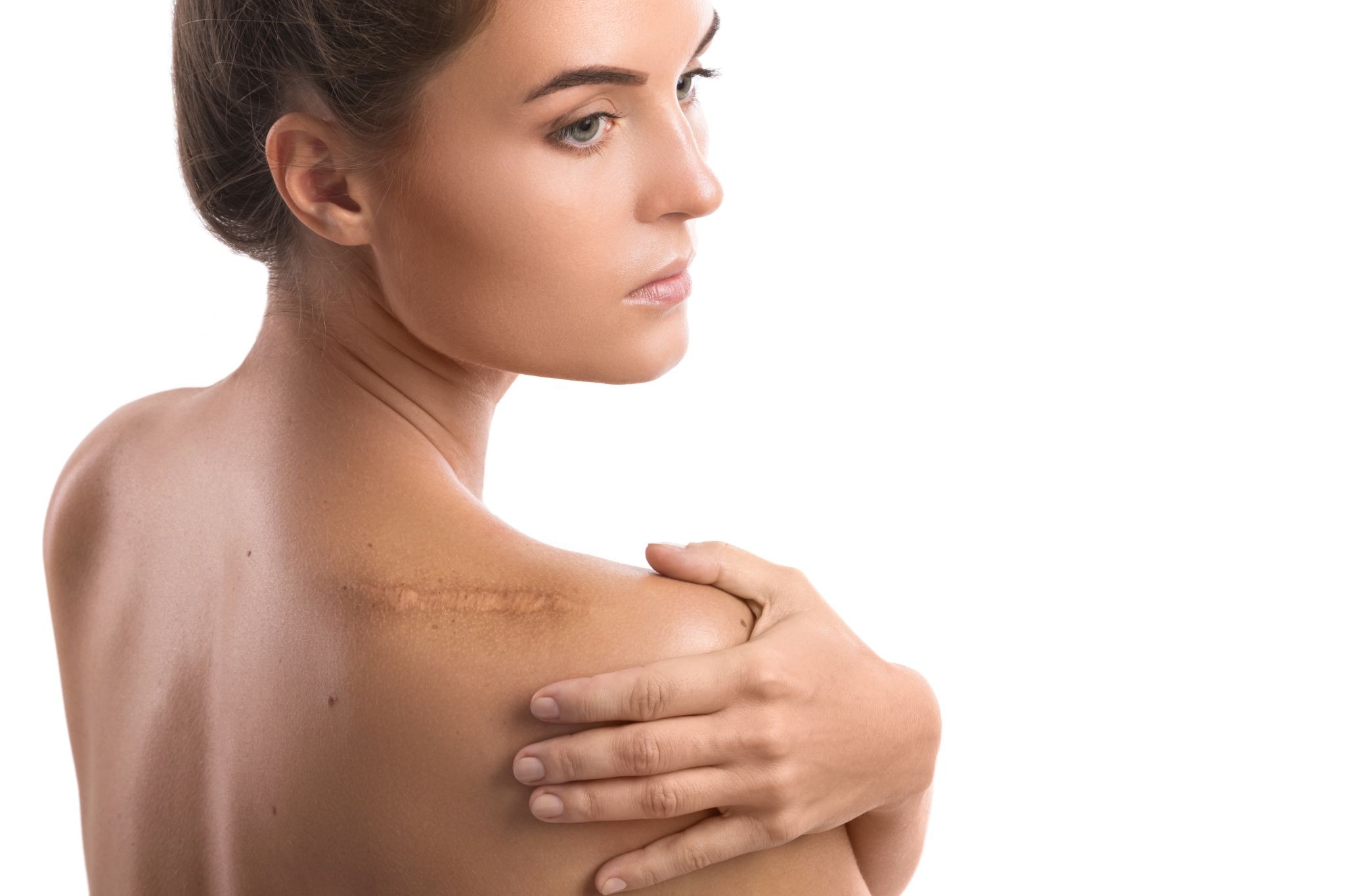 Woman showing a visible scar on her shoulder during skin evaluation