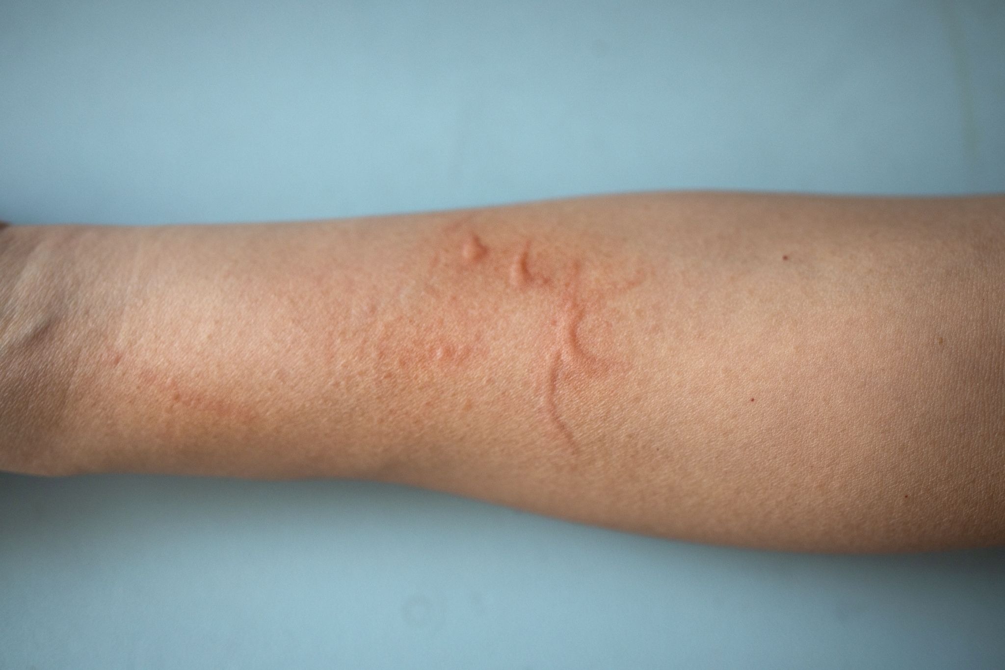 Close-up of an irritated scar on a man's arm showing redness and skin texture