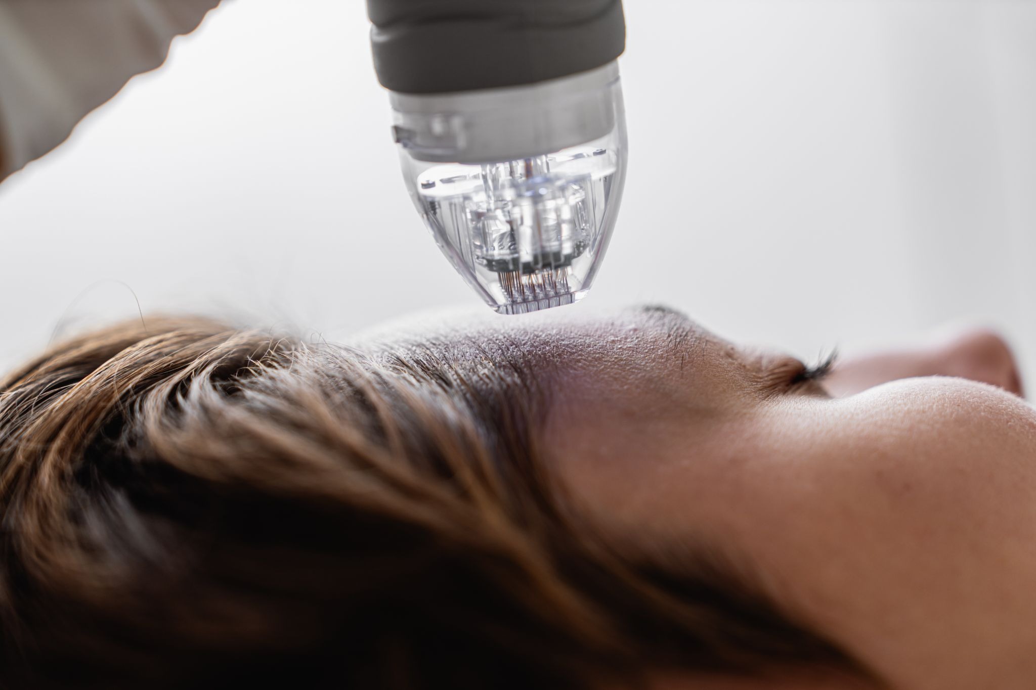 Close-up view of a microneedling procedure on a woman's forehead 