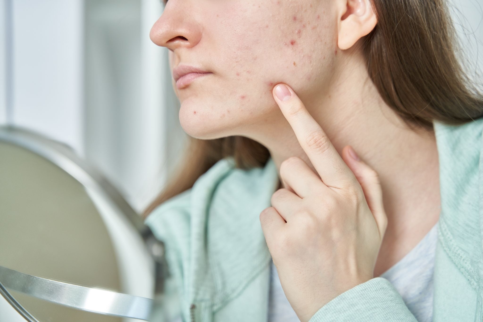 Woman touching her face with visible acne and skin imperfections in front of a mirror