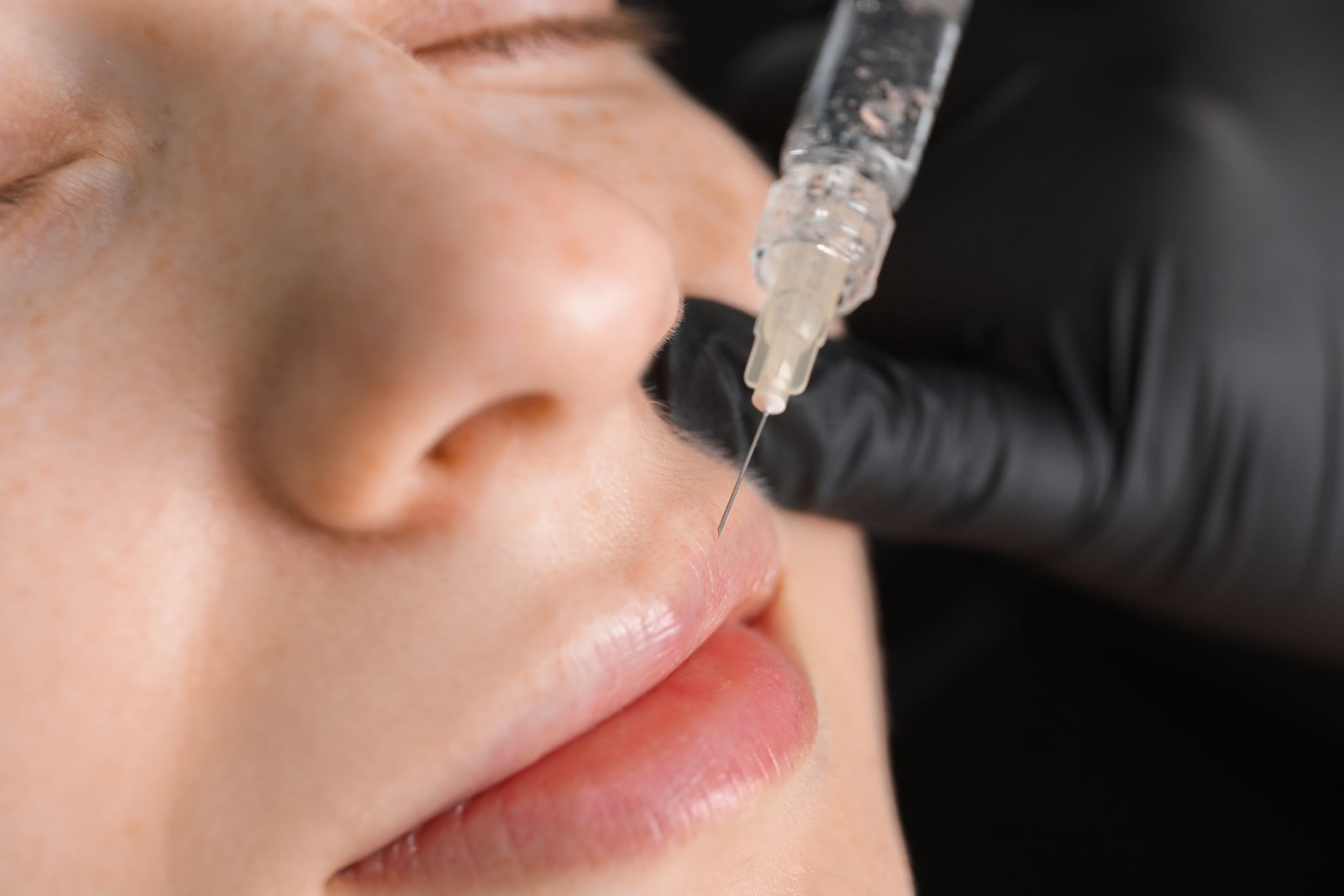 Close-up view of a woman receiving lip filler injection 