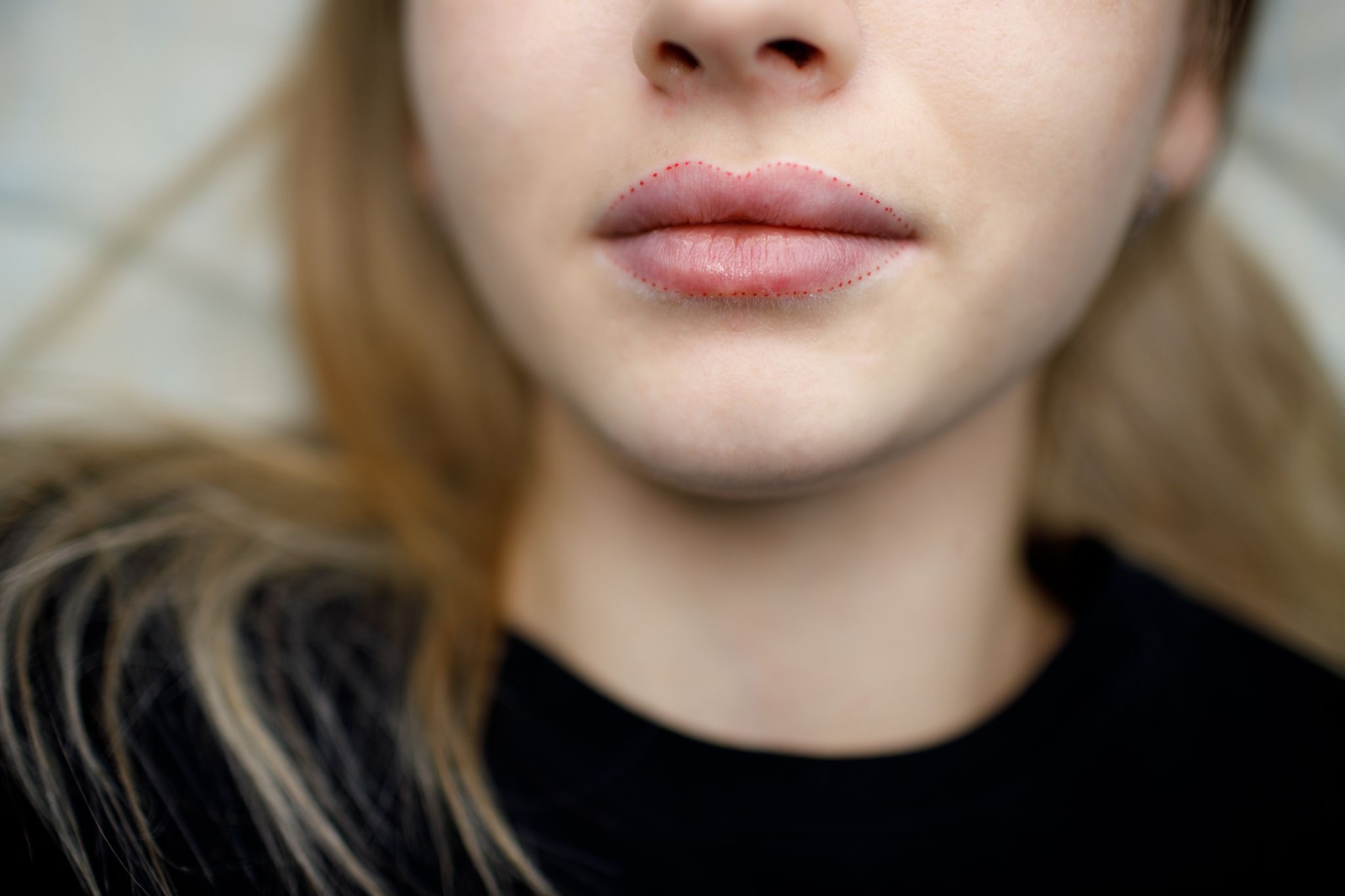 Close-up of a woman’s lips after lip filler treatment