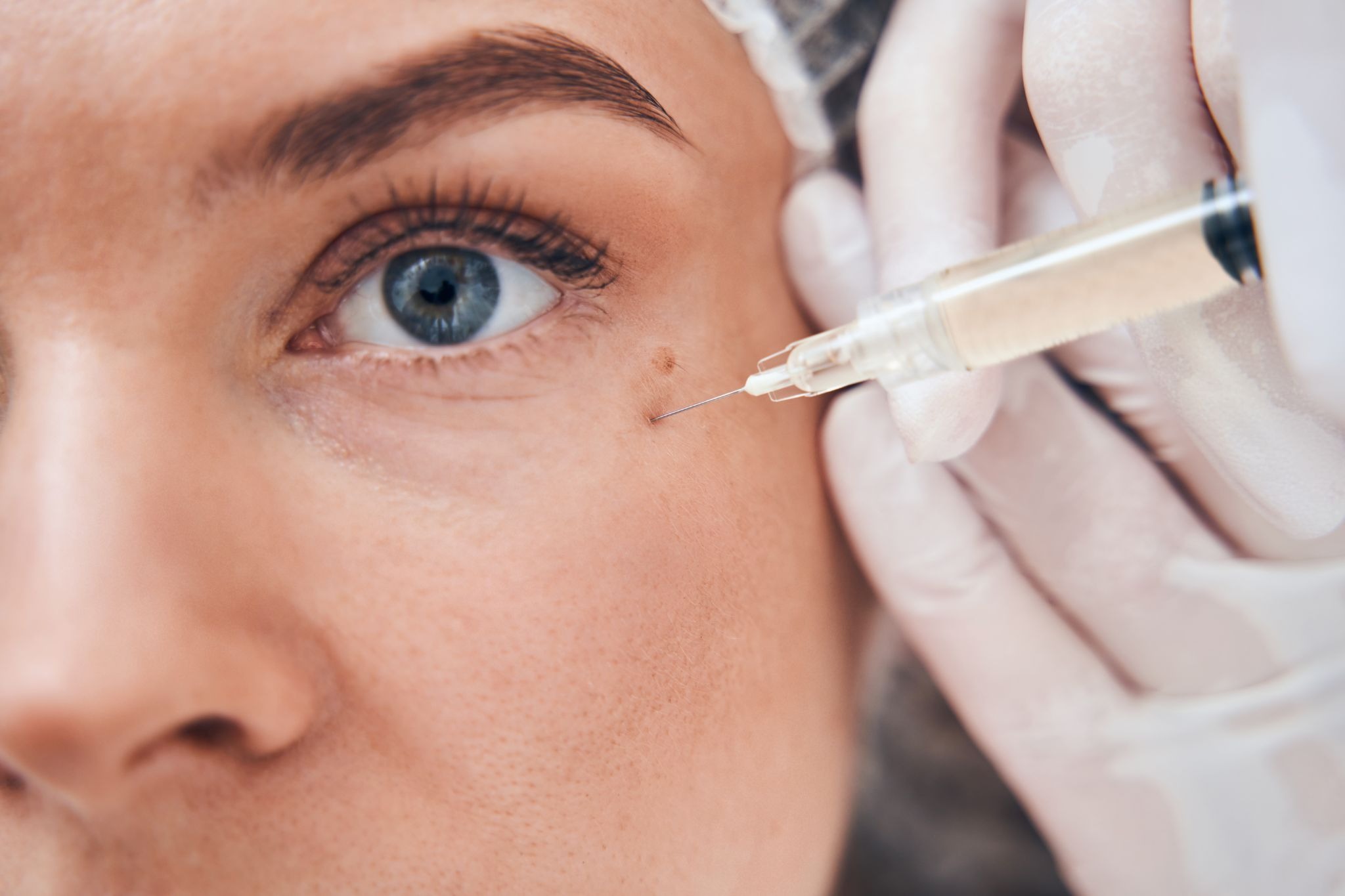 Close-up of dermal filler treatment for hollow under-eyes