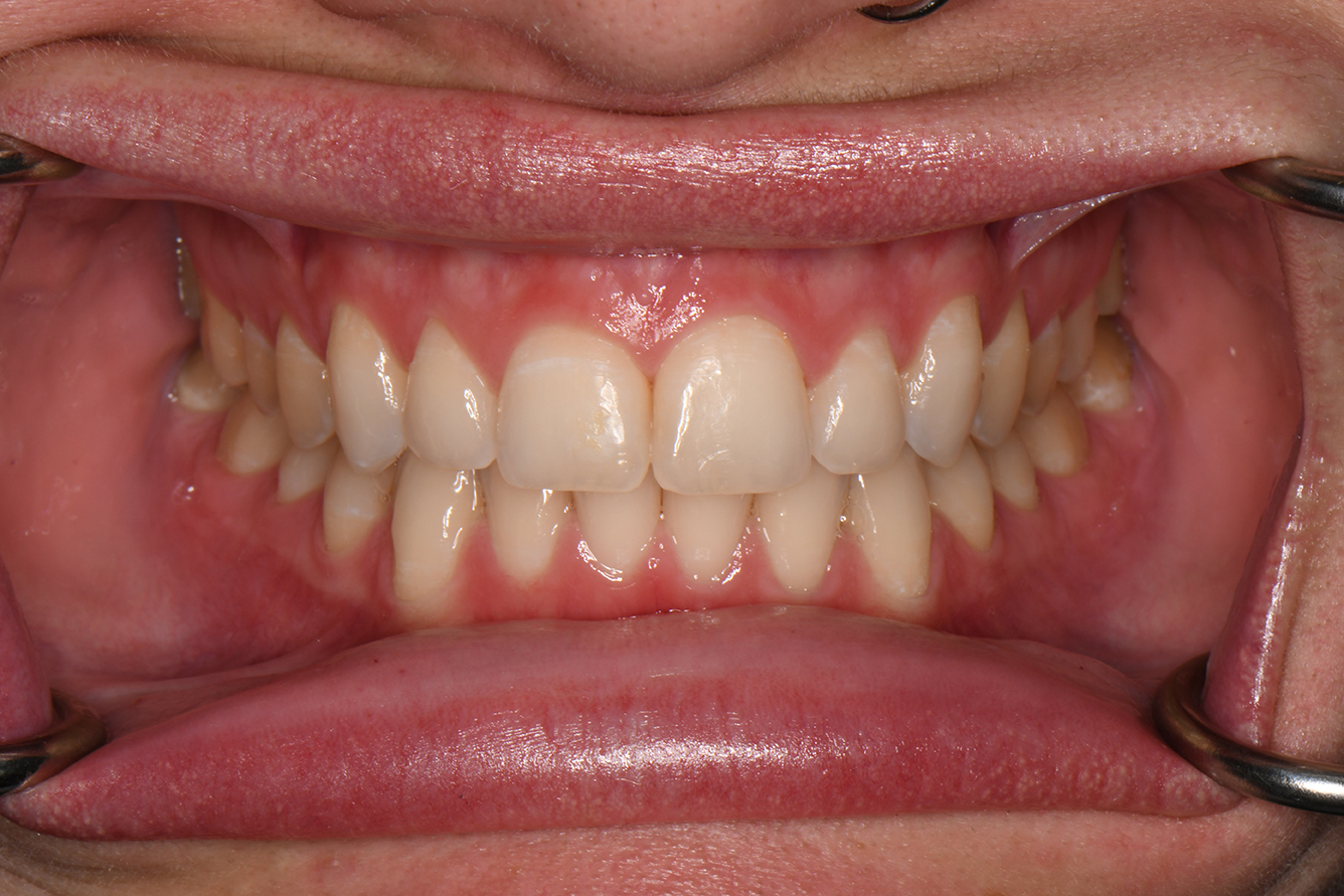 Dental Bonding - Cosmetic Dentistry in Howell, MI - LIVCO Dentistry
