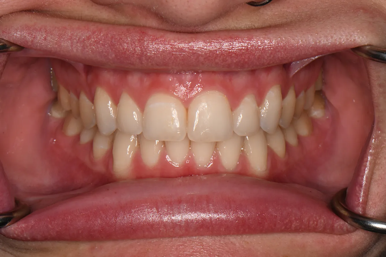 Dental Bonding - Cosmetic Dentistry in Howell, MI - LIVCO Dentistry