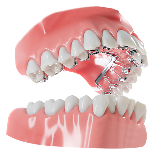 Dental model showing upper and lower teeth with an orthodontic appliance on the inner side of the upper teeth.