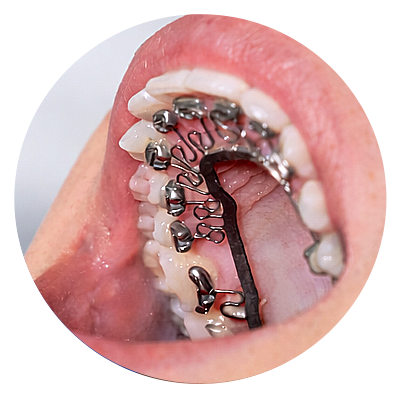 Close-up of the roof of a mouth with dental braces and orthodontic wires on the upper teeth.