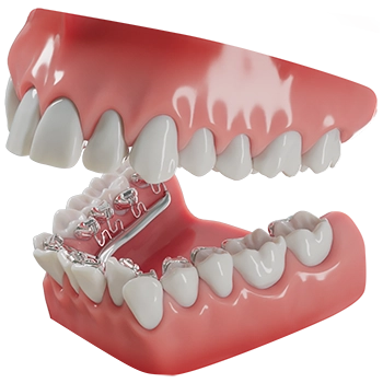 3D illustration of a dental appliance fitted on lower teeth inside a mouth model with gums and upper teeth visible.