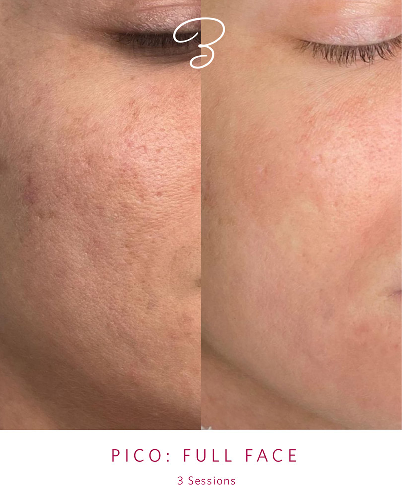 Before and after three PicoSure full face sessions, showing smoother and more even cheek texture