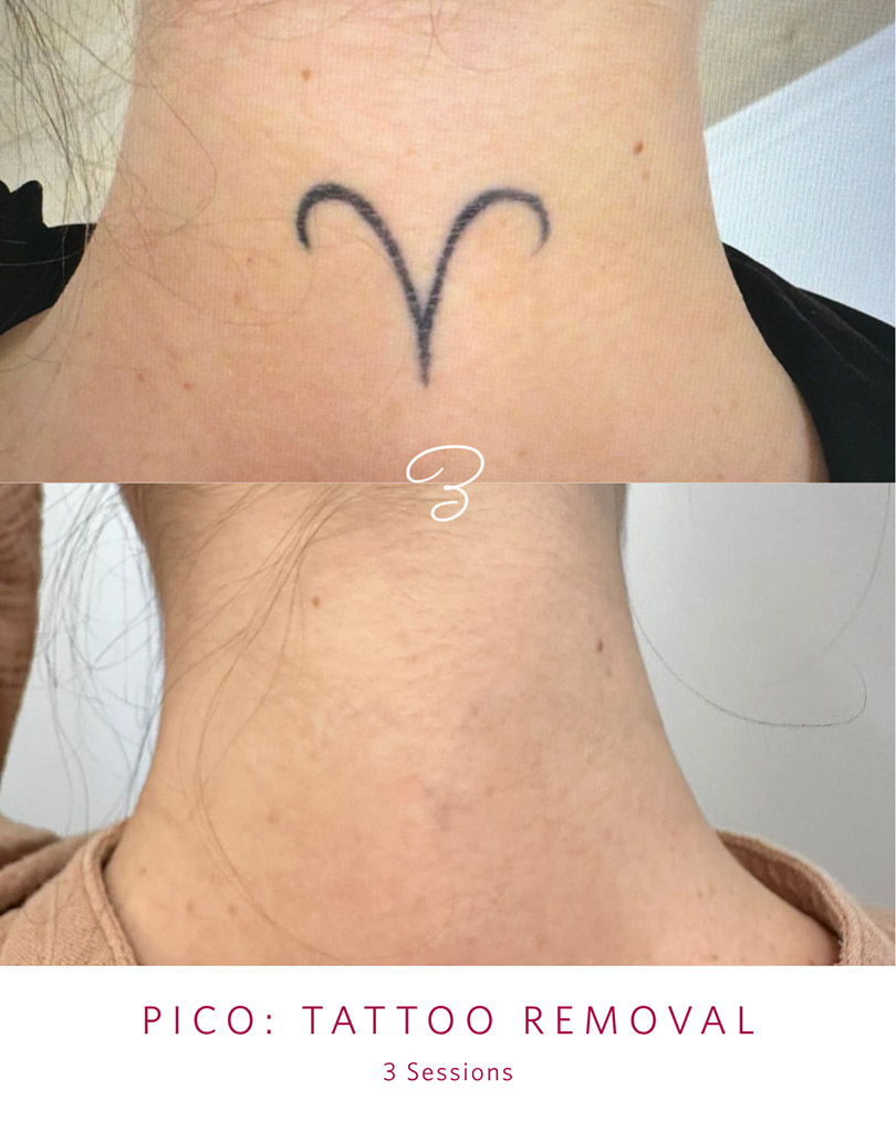 Before and after three PicoSure sessions removing a small neck tattoo
