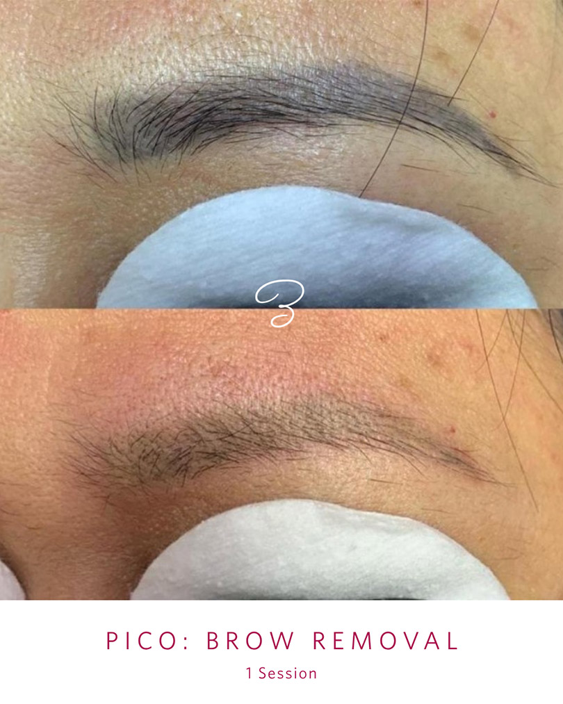 Before and after one PicoSure session lightening a cosmetic eyebrow tattoo