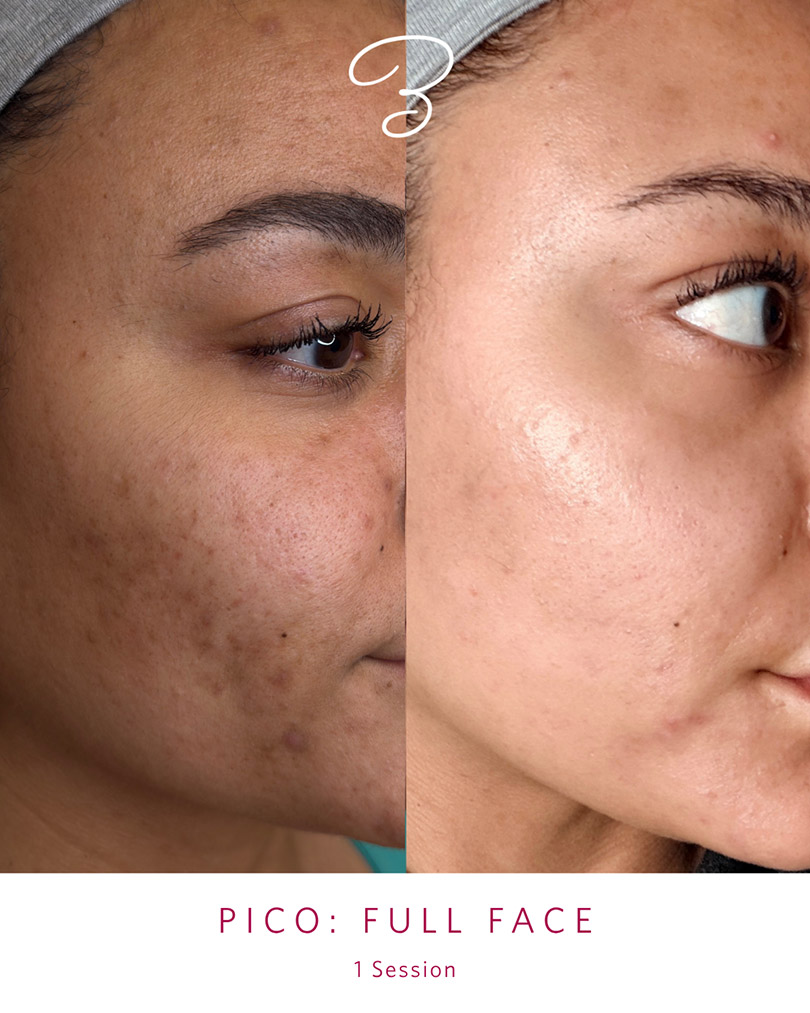 Before and after one PicoSure full face session, showing reduced acne marks and pigmentation