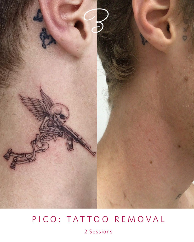 Before and after two PicoSure tattoo removal sessions on a neck tattoo
