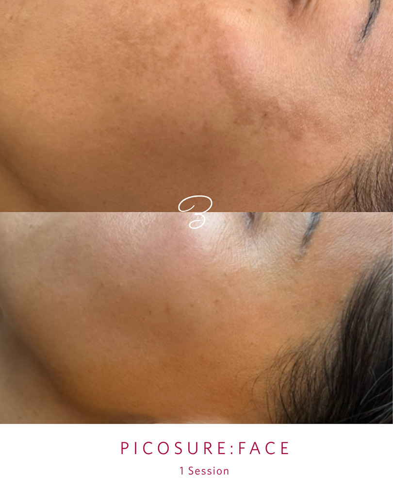 Before and after one PicoSure facial session, showing reduced pigmentation along the jawline