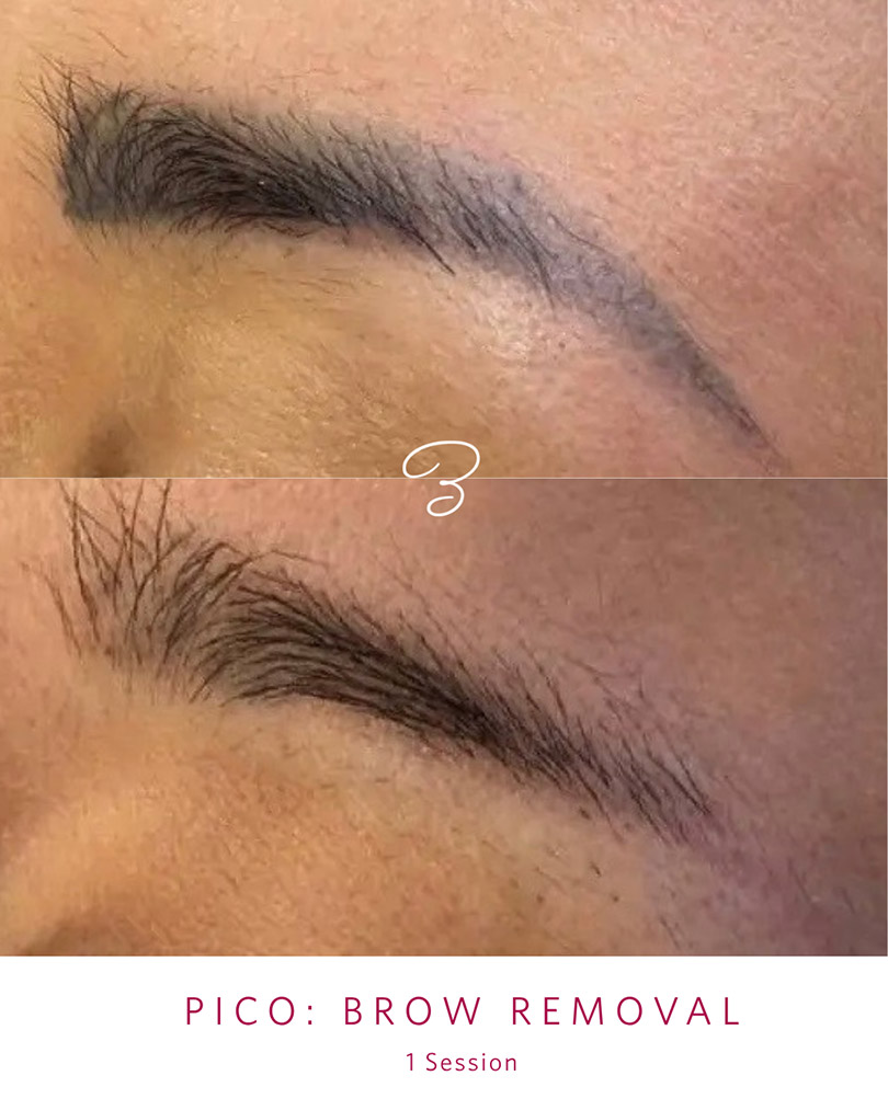 Before and after one PicoSure session lightening a cosmetic eyebrow tattoo