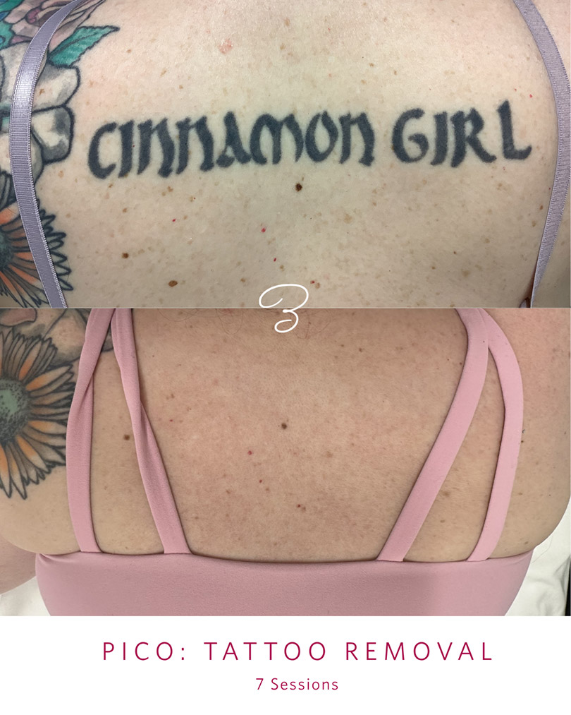Before and after seven PicoSure tattoo removal sessions on an upper back tattoo