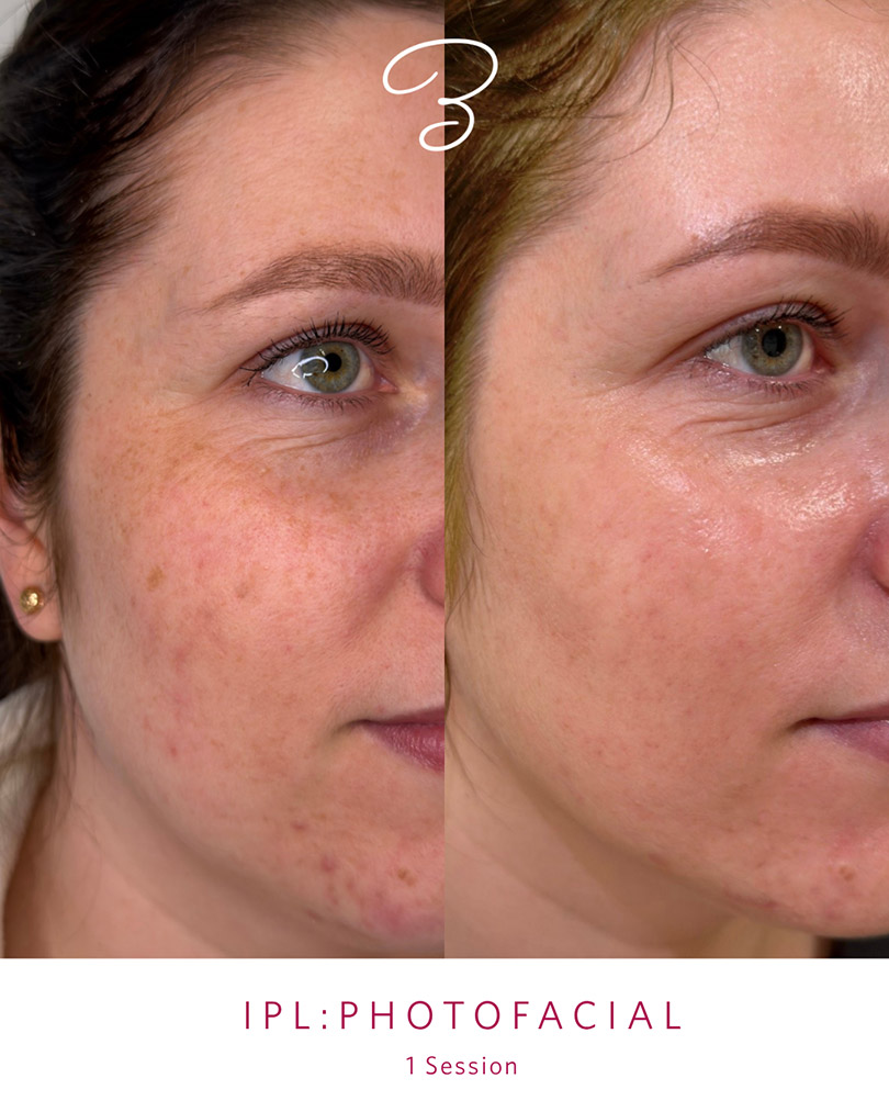 Before and after one IPL photofacial session, showing reduced facial redness and sun spots