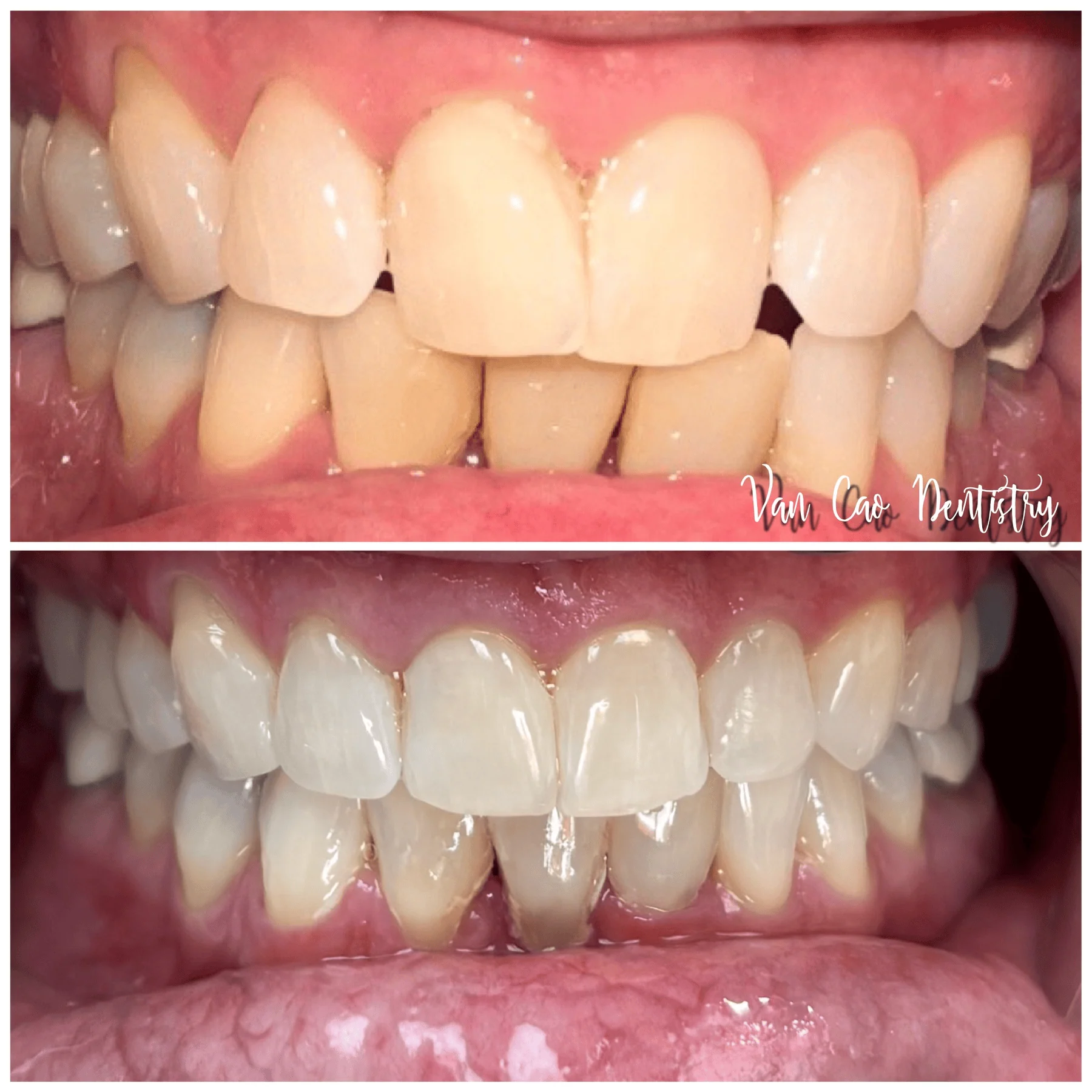This patient wanted to improve the overlapping and spacing in their smile. With Invisalign treatment followed by professional whitening, we achieved the bright, confident smile she was looking for ✨