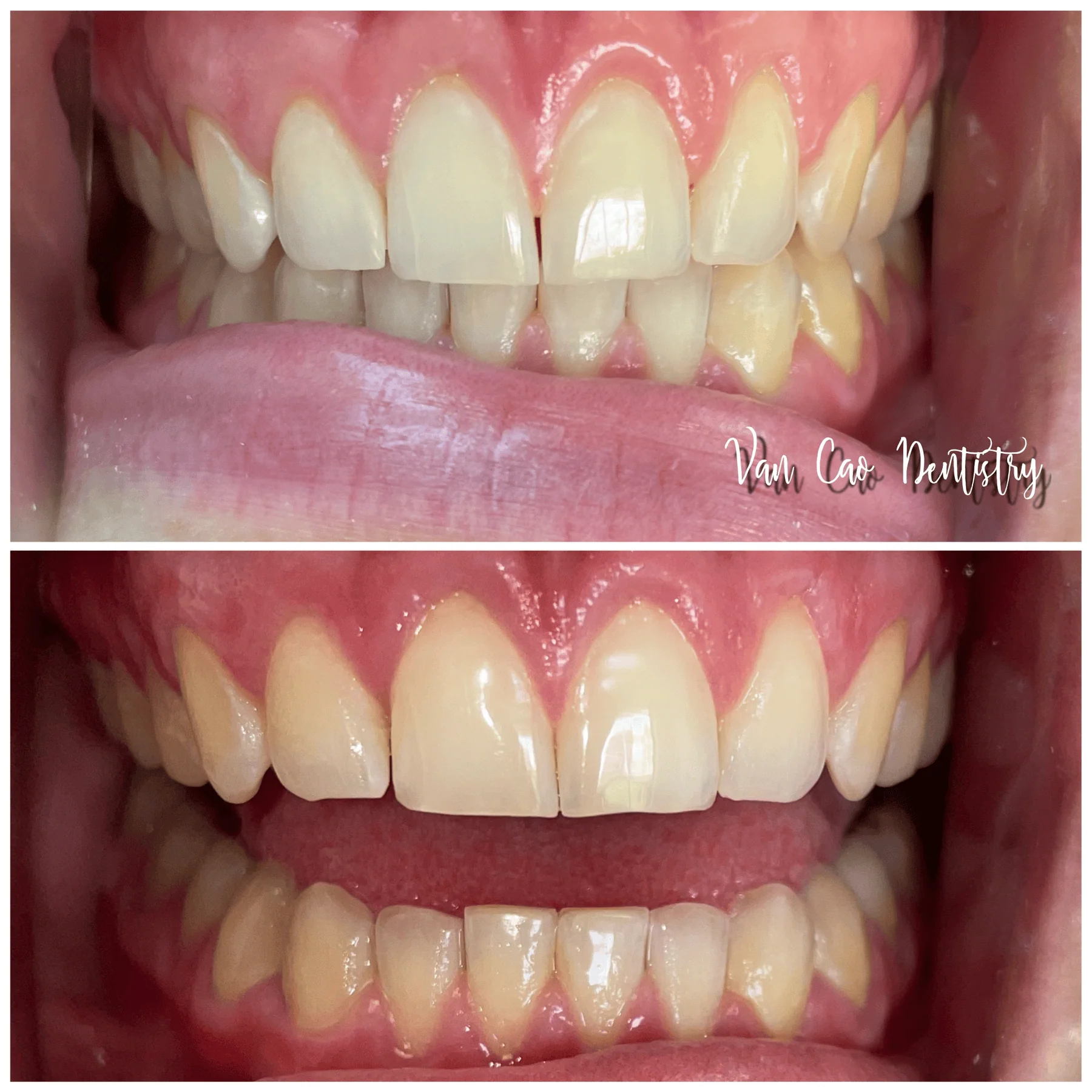 Our patient already had a beautiful smile, but wanted to close a small gap in the front. With Invisalign, we achieved the subtle enhancement she wanted—leaving her with an even more confident smile.
