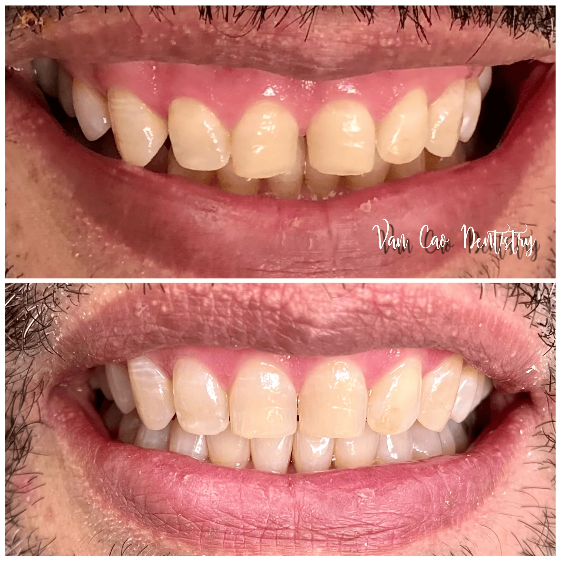 This patient’s goal was a more balanced, confident smile. Thanks to Invisalign, he got just that—and he’s thrilled with the results!