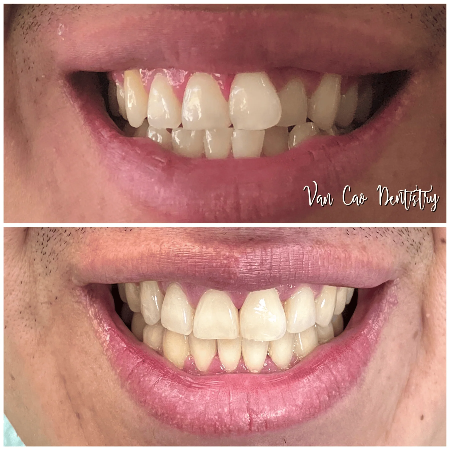 This patient wanted a straighter smile without the look of traditional braces. With Invisalign, we were able to align their teeth discreetly—resulting in a confident, beautiful smile.
