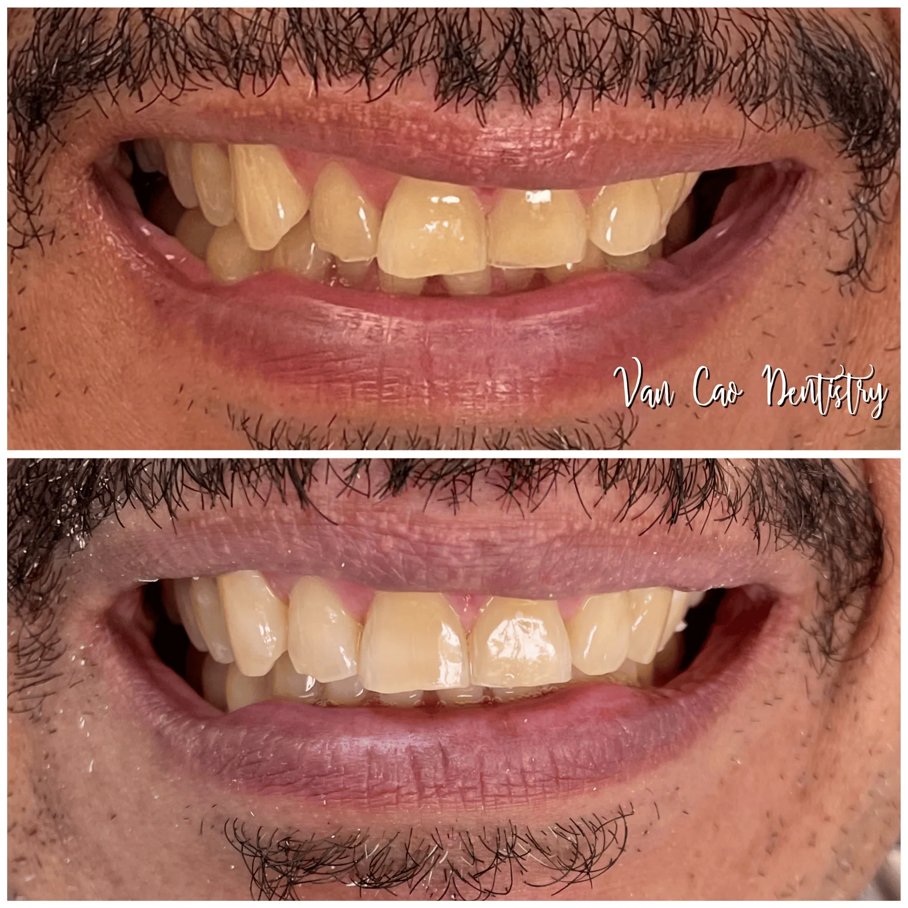 A straighter, more confident smile achieved with Invisalign. One happy patient, one beautiful result.