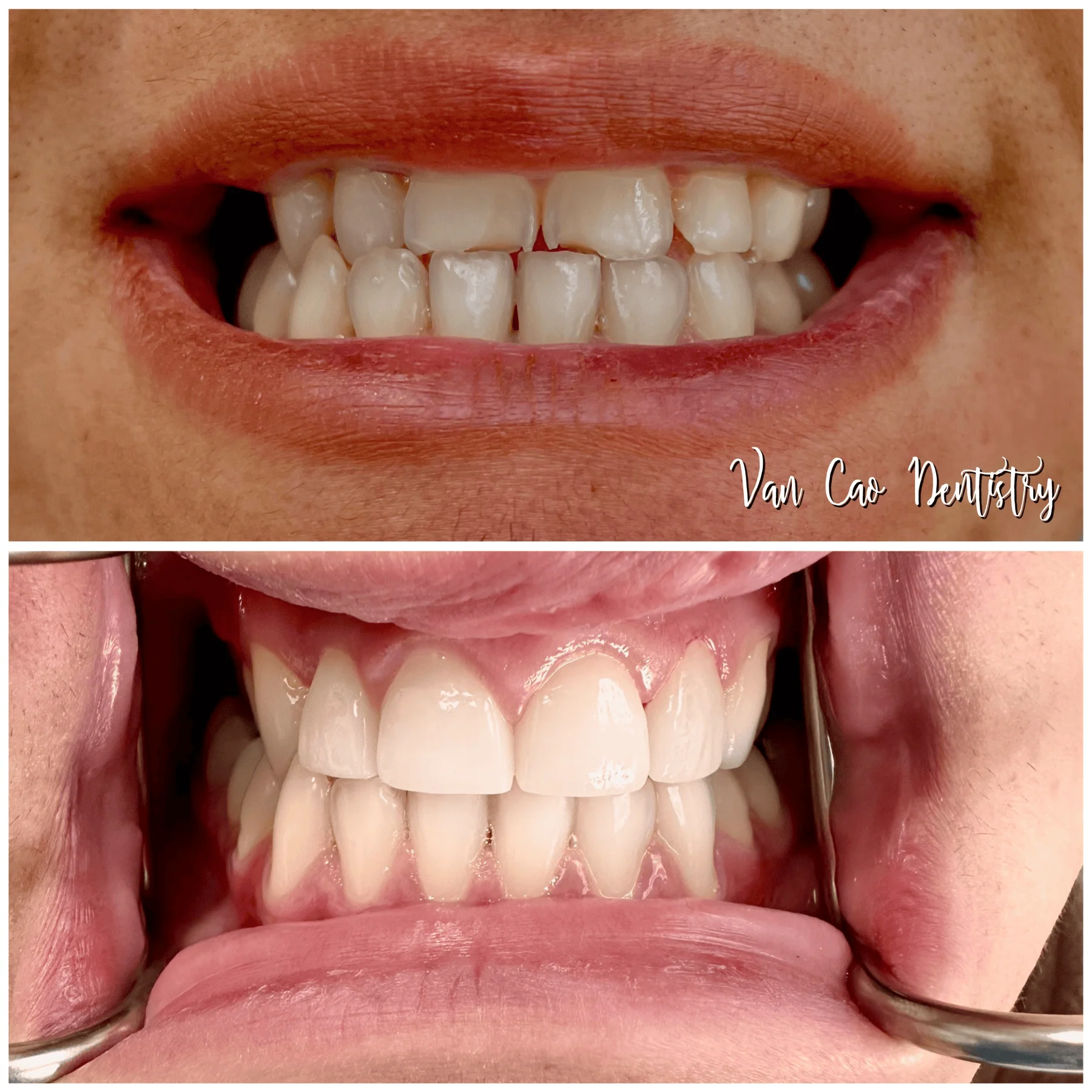 This patient wanted to restore the look of her smile. With porcelain crowns, we rejuvenated her teeth for a more youthful, confident appearance.