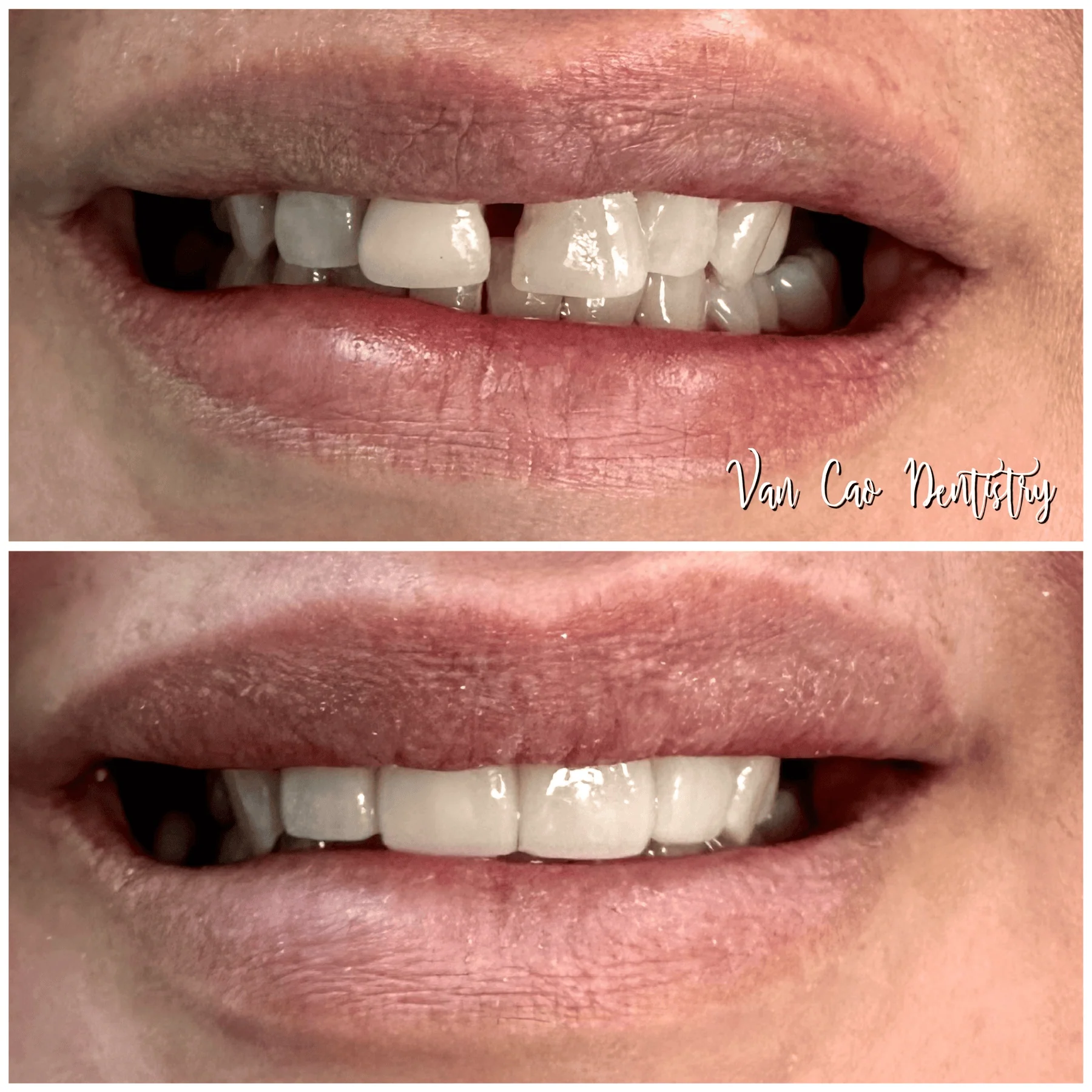 This patient was concerned about a front gap and the shape of her teeth. With crowns, we were able to close the space and create a balanced, beautiful smile.