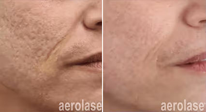Before and after image: skin rejuvenation