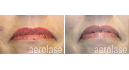 Before and after image:  Angiomas