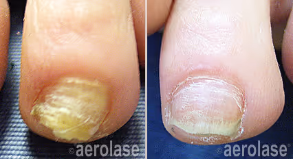 Before and after image: fungal nail