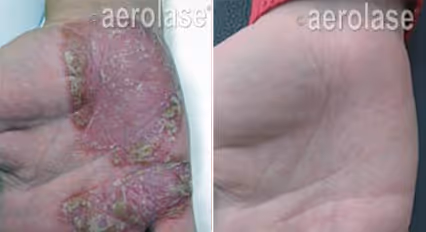Before and after image: psoriasis on hand
