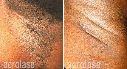 Neo Elite Aeroalse Laser for hair removal before and after