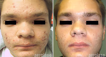 Before and after image: acne