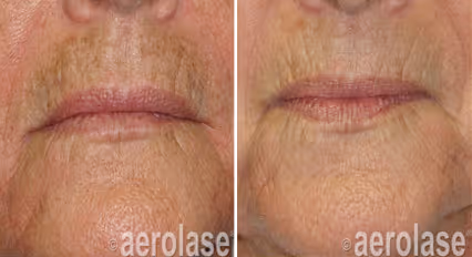 Before and after image:  melasma