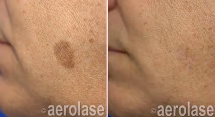 Before and after image: pigmentation