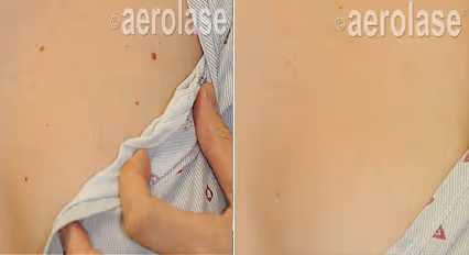 Before and after image: angioma
