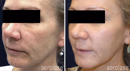 Before and after image:  skin rejuvenation